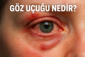 Göz Uçuğu Nedir?